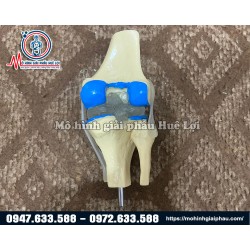 Mô hình bệnh lý khớp gối